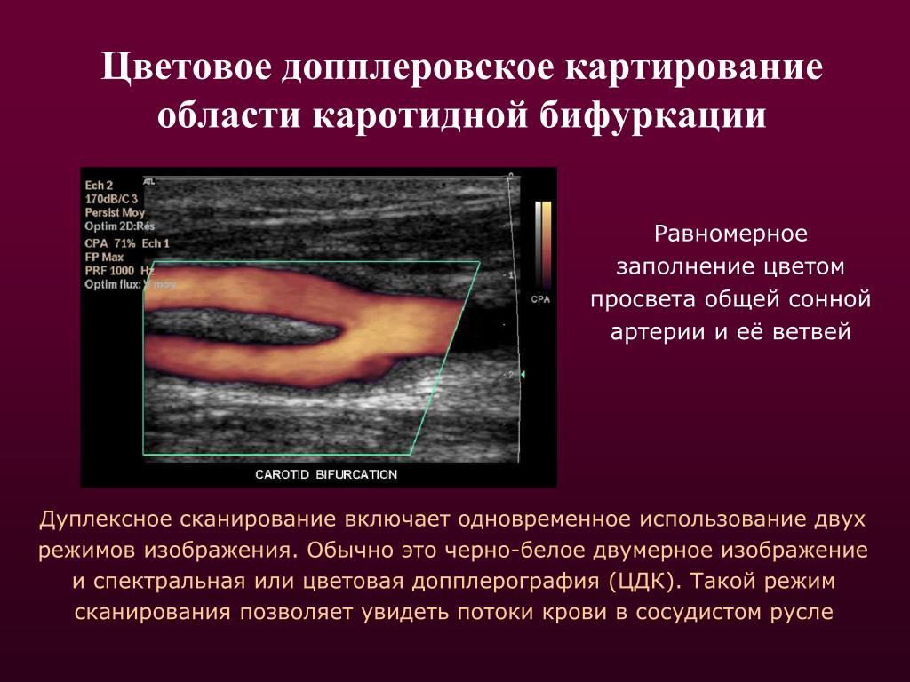 Картирование это. Цветовое допплеровское картирование кровотока. Цветовое допплеровское картирование ЦДК. Цветовой доплеровкой кортирование. Цветное дуплексное картирование.