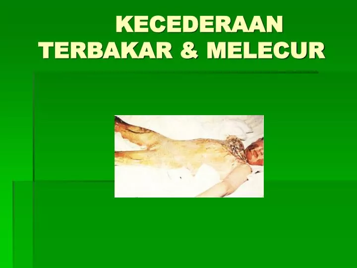 kecederaan terbakar melecur n.