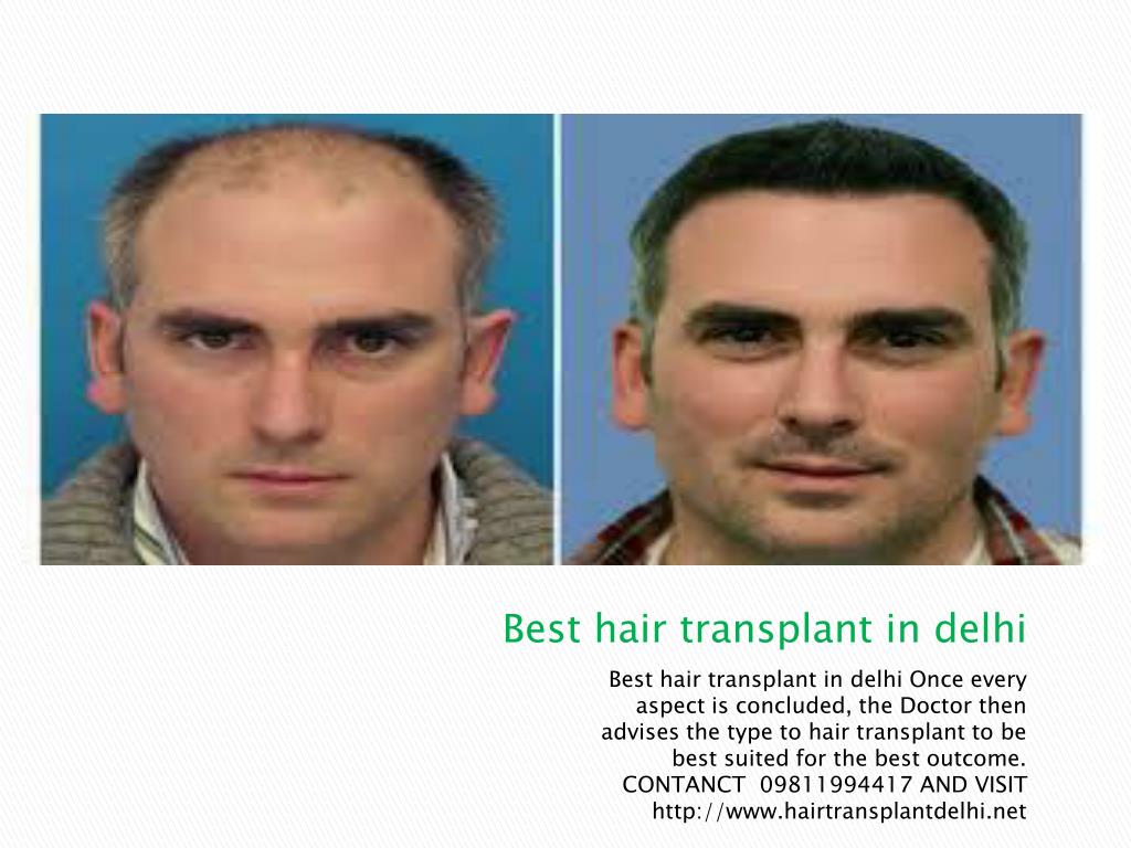 Ppt Hair Transplant Delhi Powerpoint Presentation Free Download